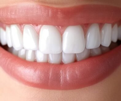 dental veneers close-up